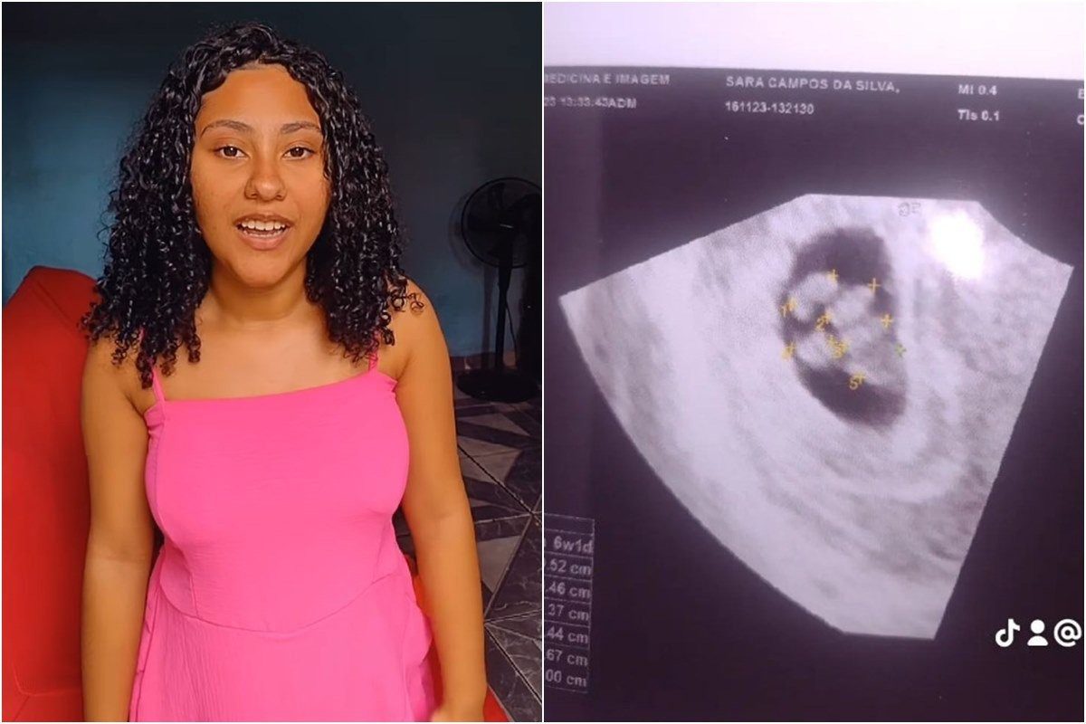 Jovem de 18 anos do Rio de Janeiro descobre gravidez rara de quíntuplos