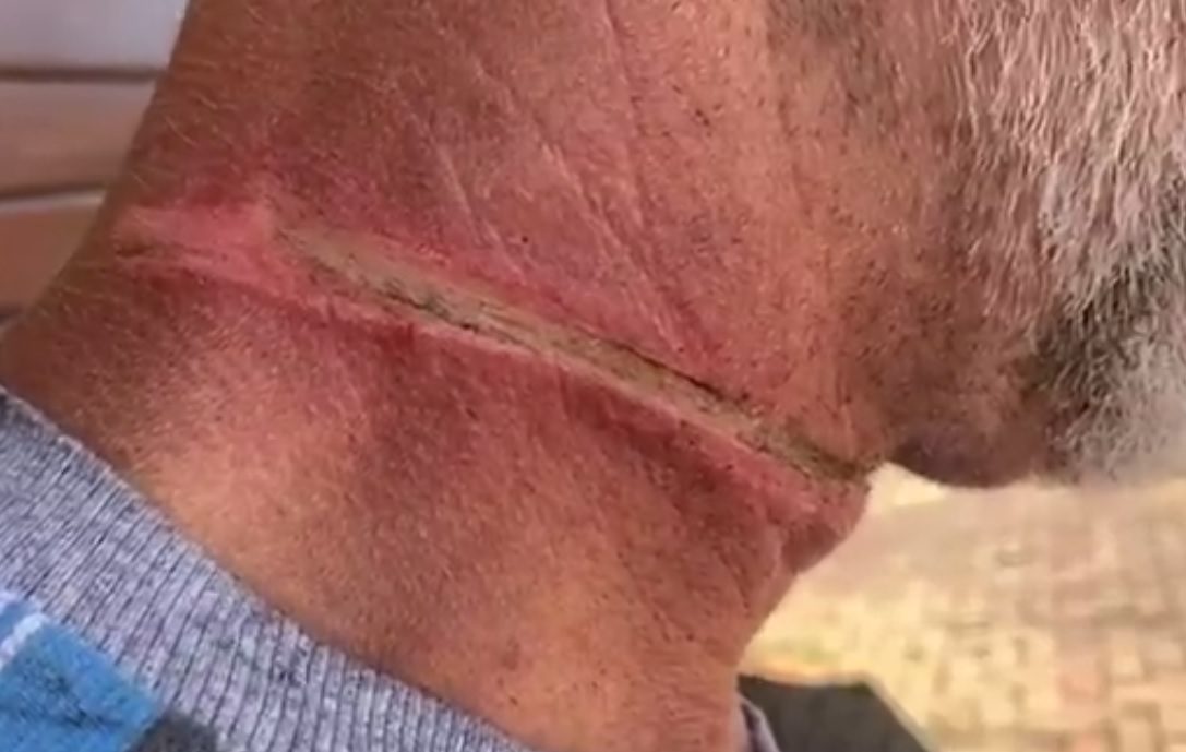 No Paraná, motociclista fica ferido após enroscar pescoço em cabo solto e cair