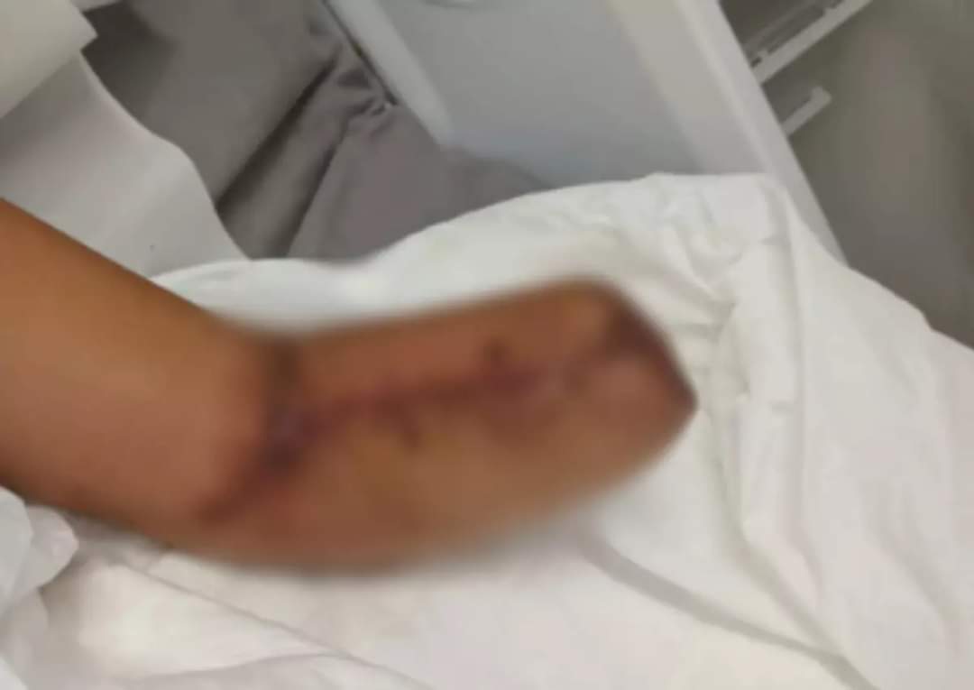 Mulher vai a hospital para dar à luz e sai com mão amputada