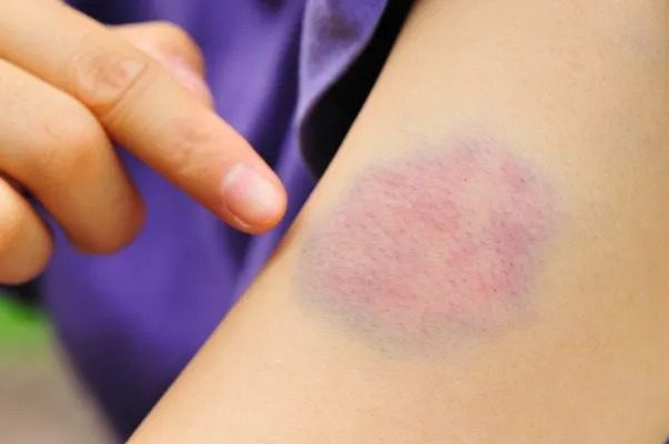 Crianças são socorridas com hematomas e contusões em General Carneiro; babá é suspeita