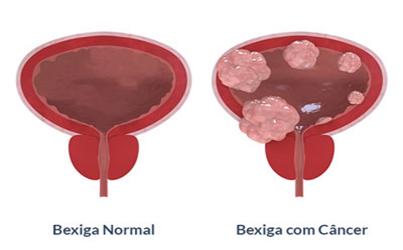 No mês da prevenção do câncer de bexiga, conheça os sinais da doença