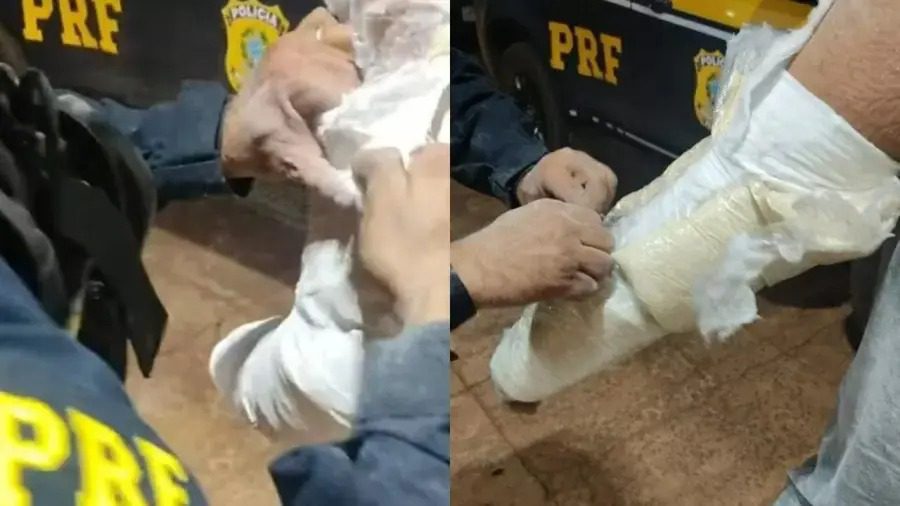 Homem é preso fingindo ter braço quebrado para transportar cocaína em gesso