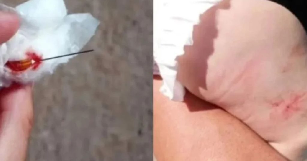 Enfermeira esquece agulha em perna de bebê durante vacina