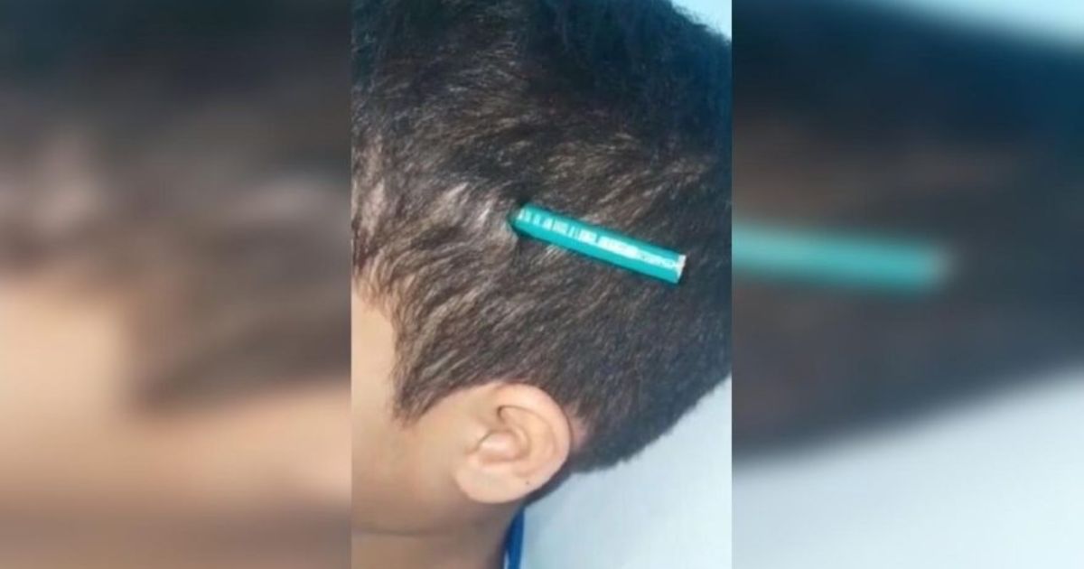 Menino de 9 anos fica com lápis cravado na cabeça após ataque de colega em escola