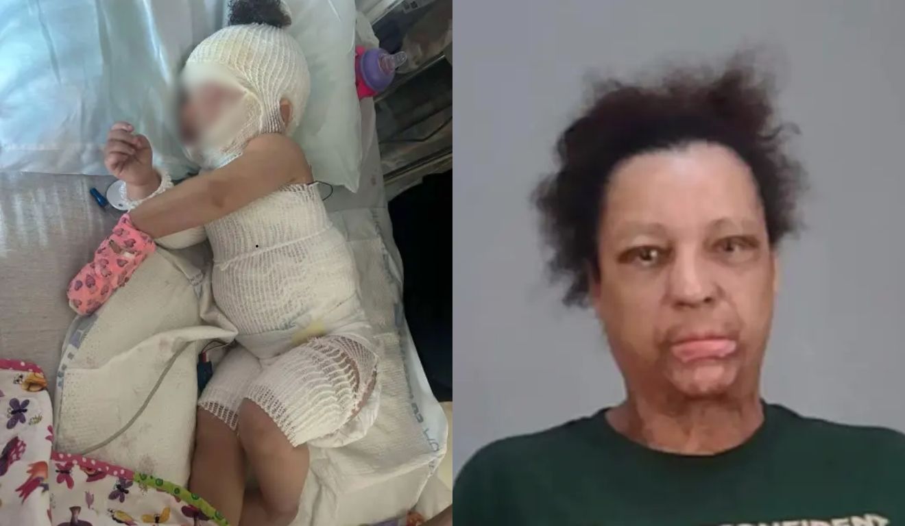 Bebê de 1 ano sofre queimaduras graves após babá dar banho de chuveiro