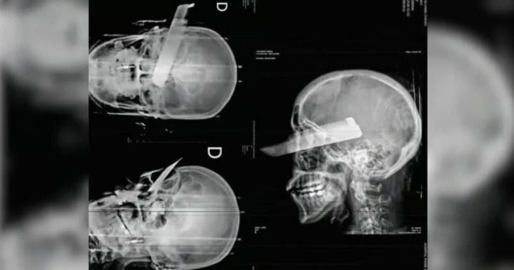 Mulher sofre uma facada no olho em tentativa de feminicídio em SC