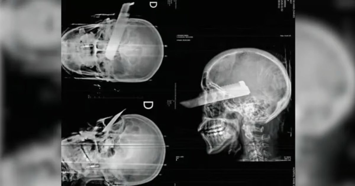 Mulher sofre uma facada no olho em tentativa de feminicídio em SC